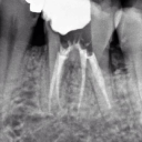 RCT Endodontics