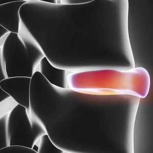 Spinal Stenosis Surgery NJ