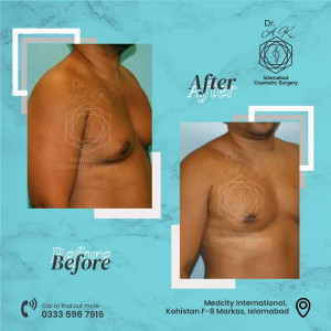 islamabadgynecomastiabydrak
